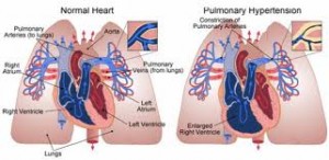 hypertensionimage